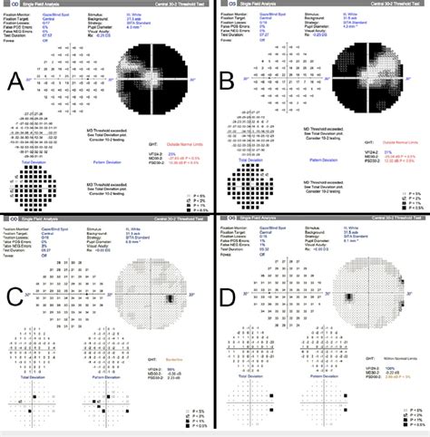 Visual Fields: Visual Field Test Strategies .